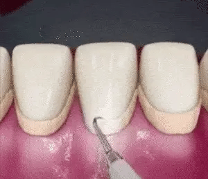 SarroClean™ Limpiador Dental Ultrasónico para Sarro Visible y Manchas – Merca Chile