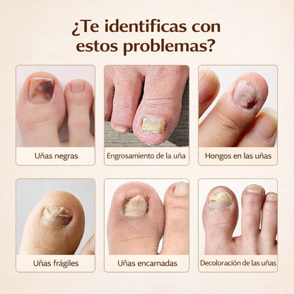 ¿Uñas amarillas o con hongos? Recupéralas mientras duermes con FungiPatch™